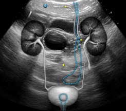 Contrast Enhanced Ultrasound of The Urinary Tract – SDMS