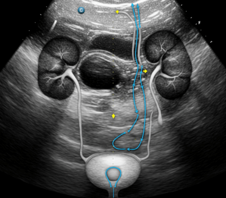 Contrast Enhanced Ultrasound of The Urinary Tract – SDMS