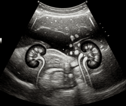 Contrast Enhanced Ultrasound of the Abdomen Including the Kidneys – SDMS