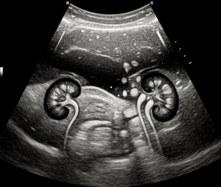 Contrast Enhanced Ultrasound of the Abdomen Including the Kidneys – SDMS